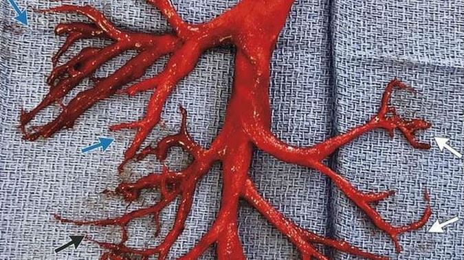 Clot shot warning: Here’s what a blood clot looks like when LIQUID blood turns into a semi-solid gelatinous mass inside your body
